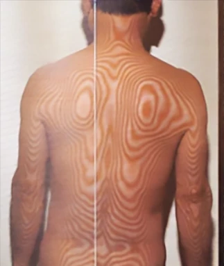 Ménière's Disease (Intractable Disease)|Examination for Body Misalignment Affecting the Autonomic Nervous System